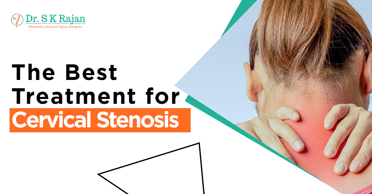 What is the best treatment for cervical stenosis